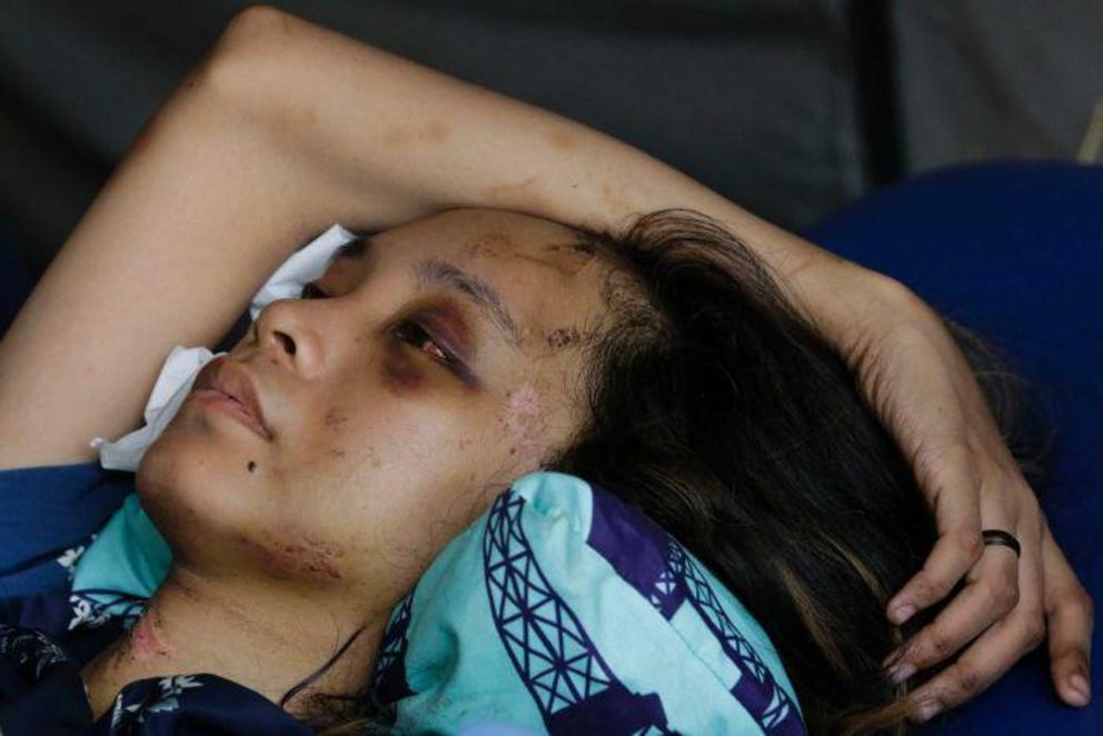 Anisa Cornelia rests after being treated at a medical tent in Palu.