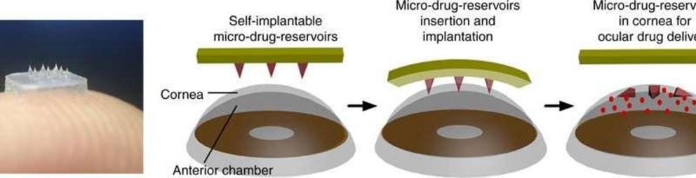 Illustration of eye-contact patch for ocular drug delivery. The eye patch is equipped with an array of self-implantable micro-drug-reservoirs. 