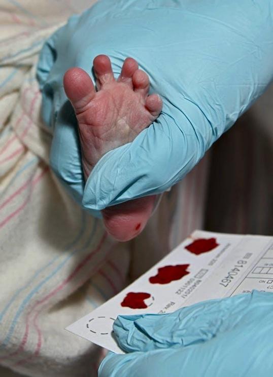 A 1-day-old baby boy’s heel is pricked for blood during a newborn screening to detect phenylketonuria (PKU) and many other disorders.