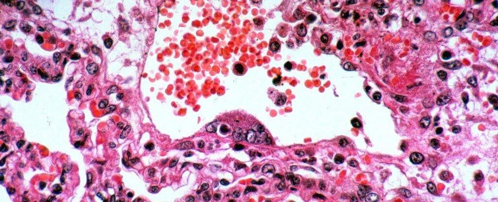 This slide shows Nipah virus in pig lung from Malaysia. (Peter Hooper/CSIRO/Wikimedia)