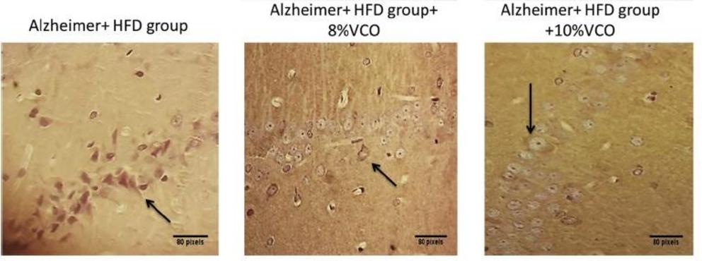 Their study found that the rats fed VCO “improved hippocampus histological changes, reduced A? plaques and phosphorylated Tau.” 