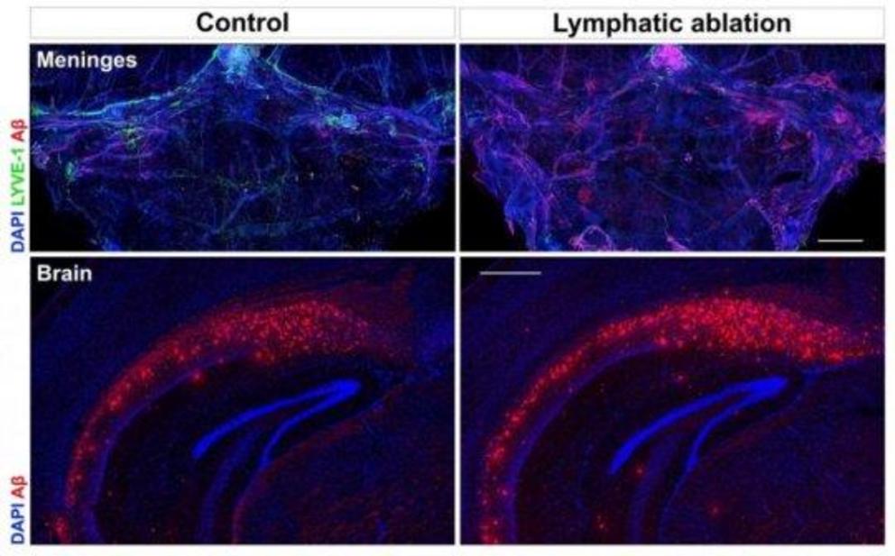 Obstructing lymphatic vessels (in green) in a mouse model of Alzheimer's disease significantly increased the accumulation of harmful plaques in the brain. 