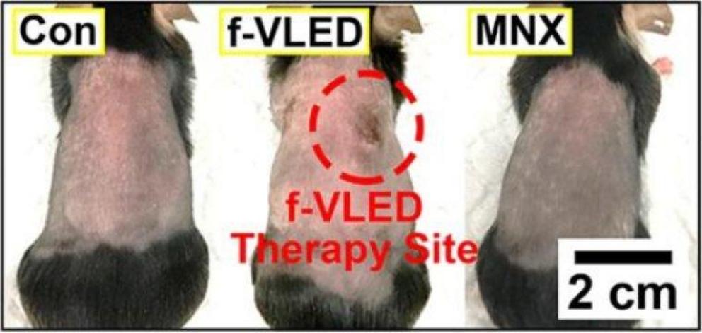 Treating shaved mice with flexible vertical ?LEDs (f-VLEDs) regrows hair faster than no treatment (Con) or minoxidil injections (MNX).  Credit: American Chemical Society
