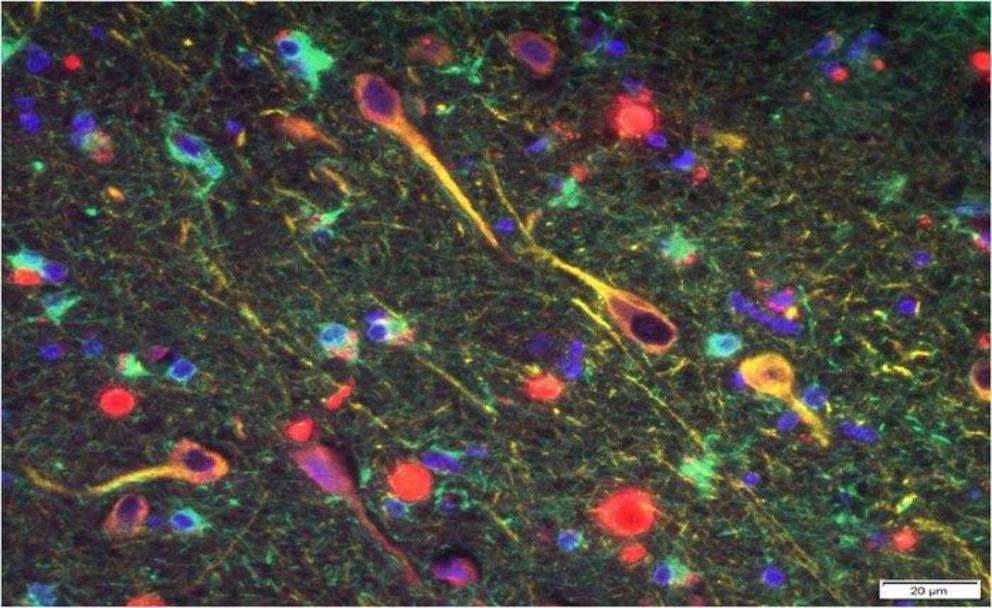 P. gingivalis' gingipains (red) among neurons in the brain of a patient with Alzheimer's 