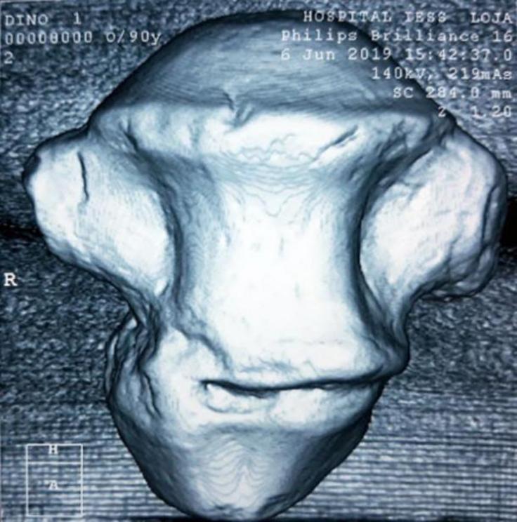 Analysis of one of the vertebrae.