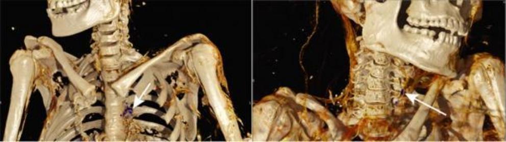 Computed Tomography Images Showing Calcified Atherosclerotic Plaques. Arrows indicate calcified atherosclerotic plaques.