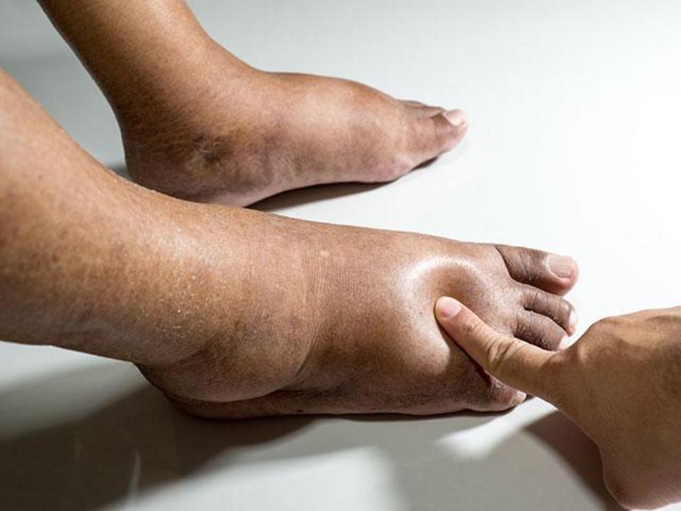 What Can Poor Circulation Lead To In Your Feet