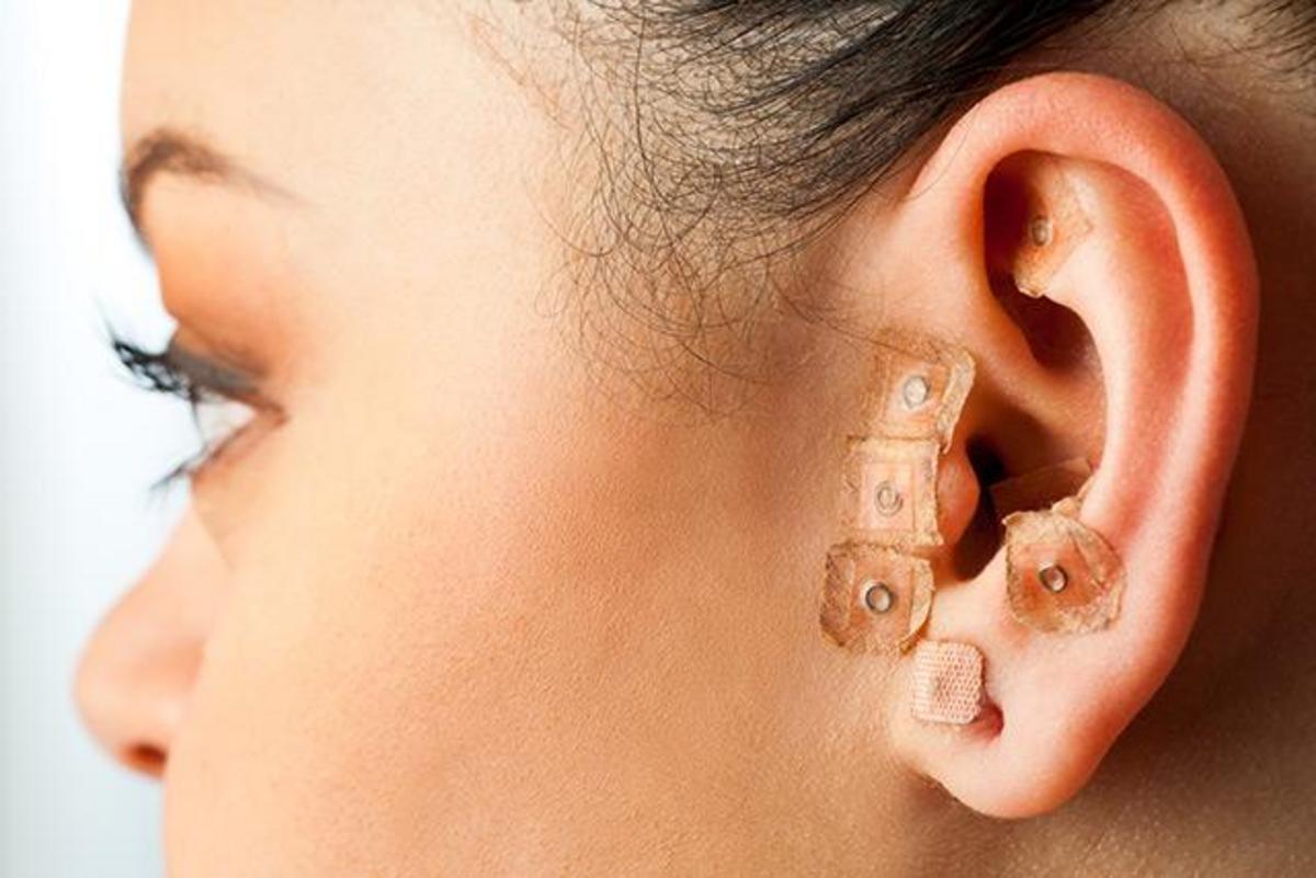 ear-acupuncture-effective-at-improving-maintaining-effectiveness-of