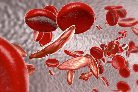 misshapen red blood cells