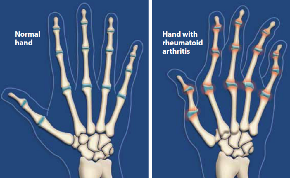 Sintomas artritis reactiva