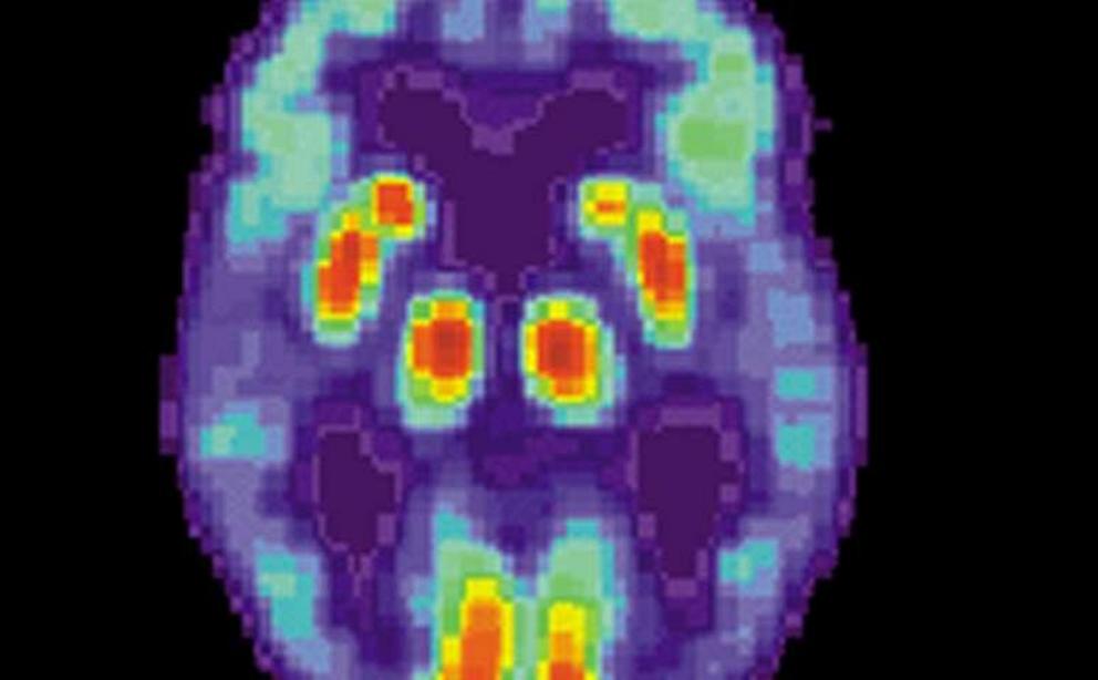 PET scan of a human brain with Alzheimer's disease. Credit: public domain