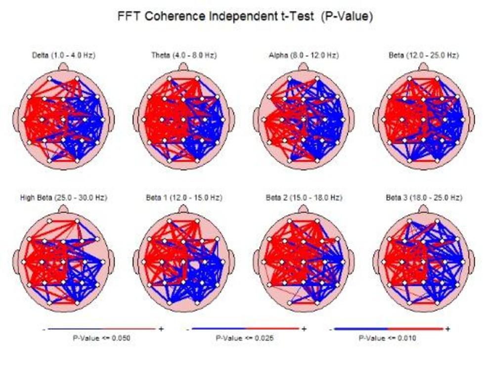 Figure 2. T-tests show the difference in brain states between pre- (red) and post-PK (blue) intervention in a female office manager