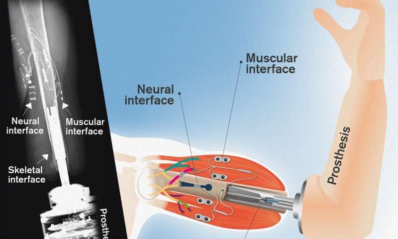 Mind-controlled Arm Prostheses That Can 'feel' - Nexus Newsfeed