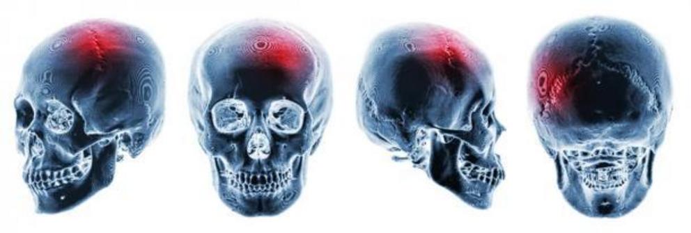 It is believed that a person’s special abilities from genetic memory can appear after significant trauma to the brain has occurred. Pictured X-rays of human skulls with apparent head trauma.