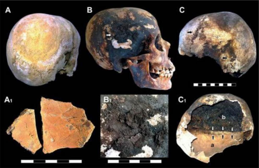 Red and black mineral incrustations detected in Vesuvius victims' skulls.