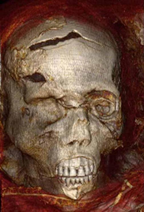 A CT scan of Seqenenre’s face shows head wounds.