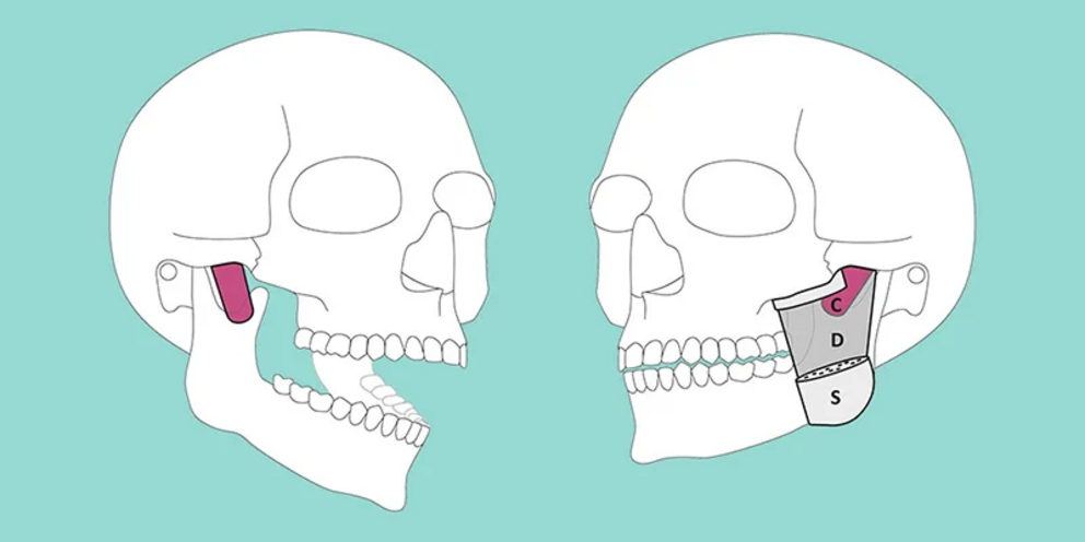 The masseter muscle has a superficial (S), a deep (D), and a deeper layer (C = coronoid).