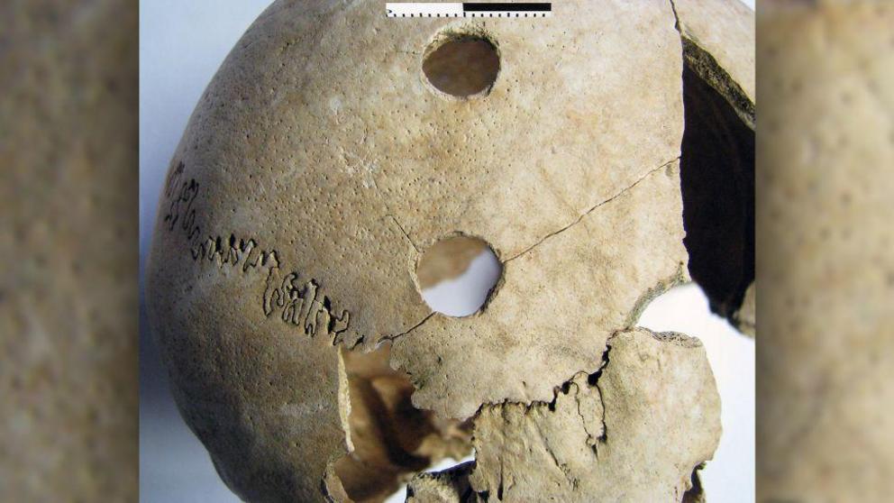 Three penetrating injuries on the right side of the skull of a young adult female from Poto?ani.