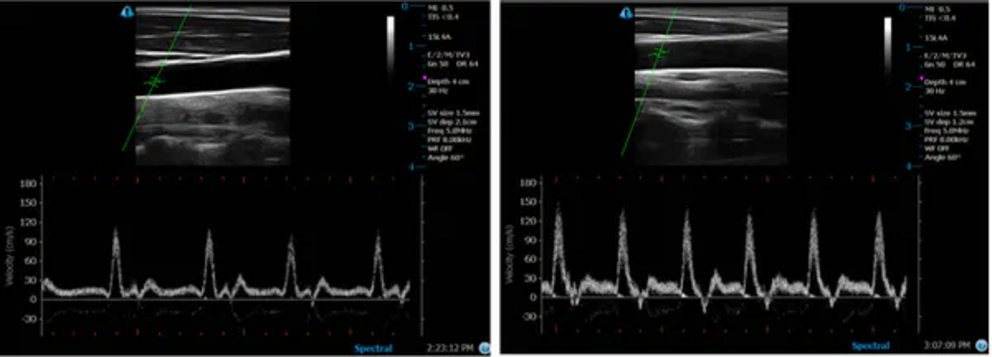 Ultrasound images showing the blood flow velocity in the common carotid artery of the neck before and immediately after hot tub bathing.