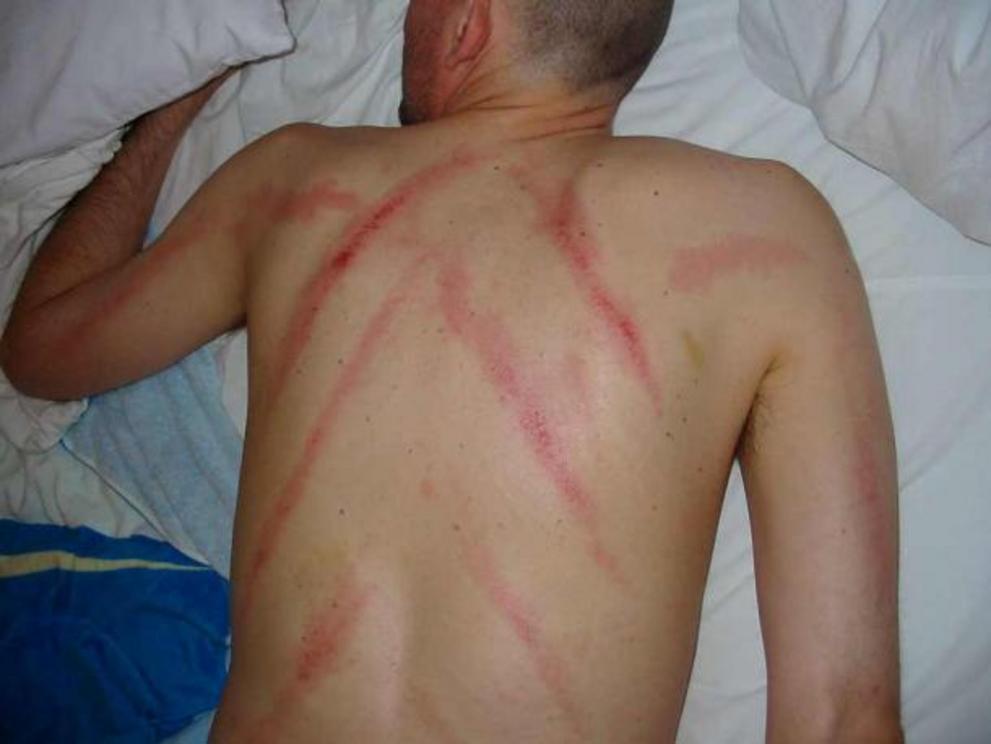 A patient after a Gua Sha back treatment.