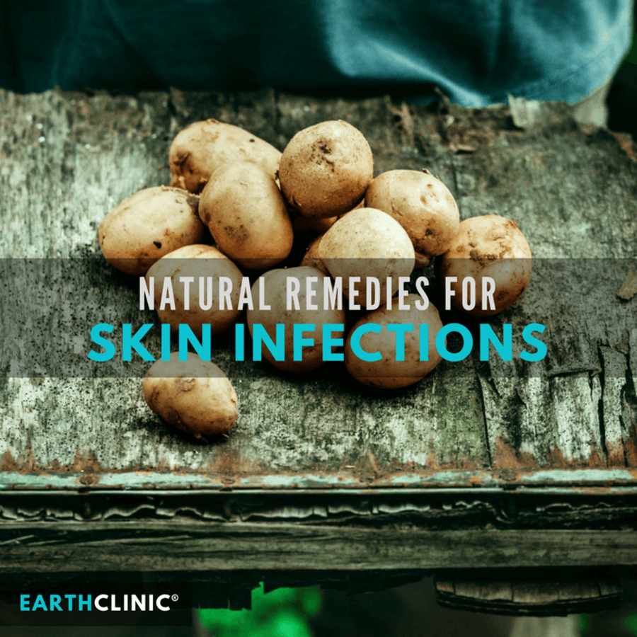 skin-infection-remedies-nexus-newsfeed