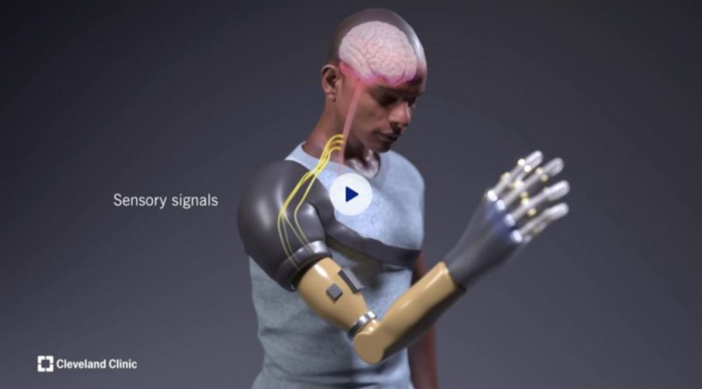 Bionic Arm Restores Natural Behaviors In Patients With Upper Limb