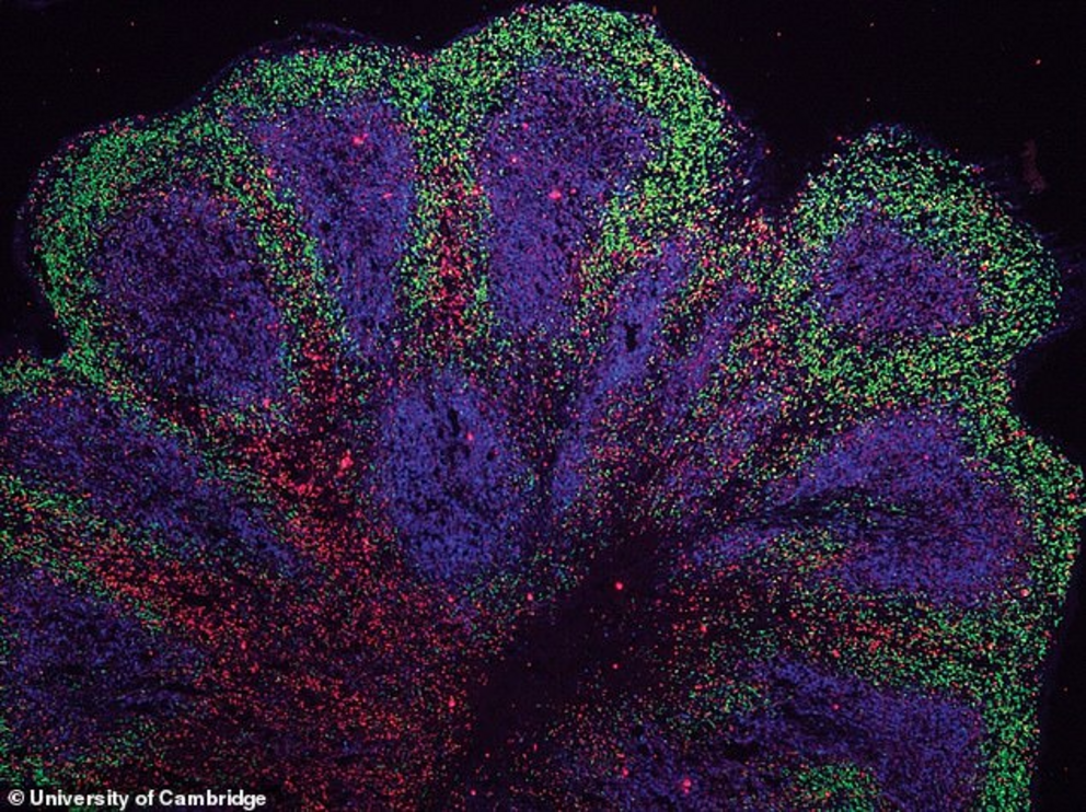 Mini brains have been grown in the lab out of cells taken from dementia and motor neurone patients, opening the door for new treatments, according to researchers