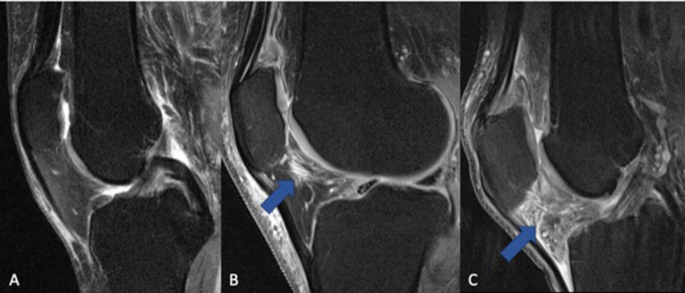 The fat pad adjacent to the kneecap (Hoffa’s fat pad, infrapatellar fat pad) can change in signal on MRI when the knee is inflamed. (A) Normal knee without signs of inflammation. (B) Arrow pointing on a circumscribed area with higher signal (bright lines)