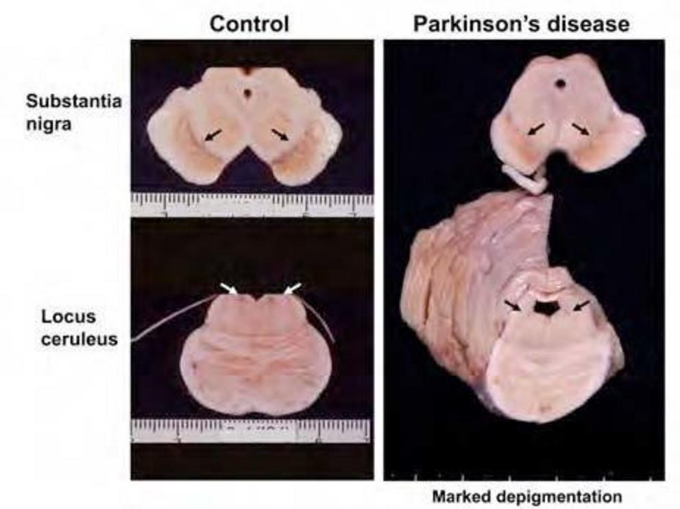 Figure 1. Midbrain and upper pons. The substantia nigra and locus coeruleus in the patient with Parkinson’s disease show marked depigmentation as compared with those of controls.