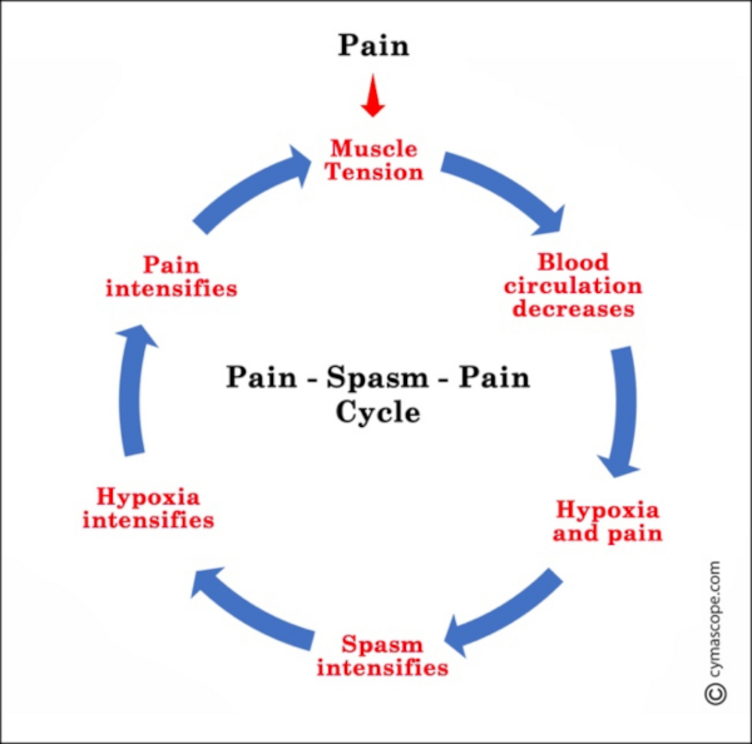 Pain > Muscle tension > Blood circulation decreases > Hypoxia and pain > Spasm intensifies > Hypoxia intensifies > Pain intensifies