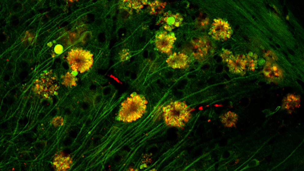 Flower-like formations in neurons of a mouse with Alzheimer's.