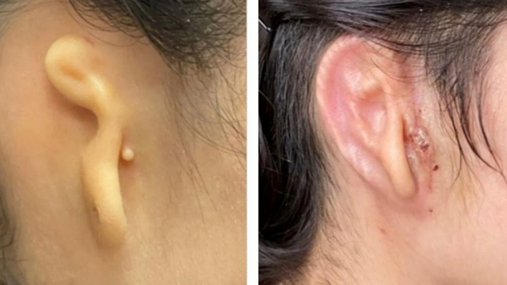 Patient before transplant (left) and 30 days after the procedure (right).