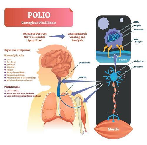 Polio Detected In New York, First US Case Since 2013 - Nexus Newsfeed