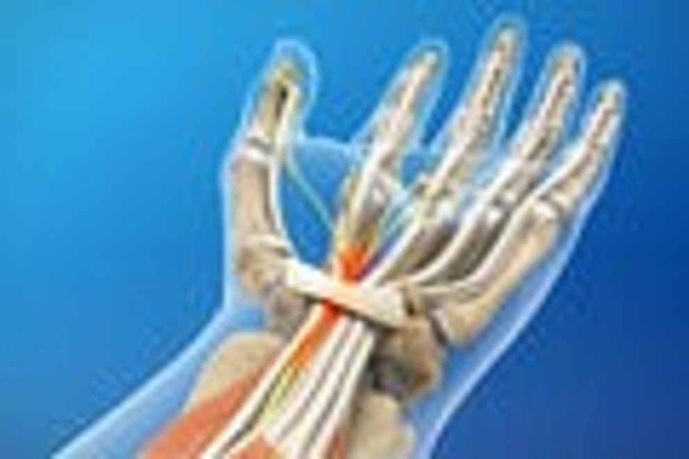 The forgotten history of carpal tunnel syndrome - Nexus Newsfeed