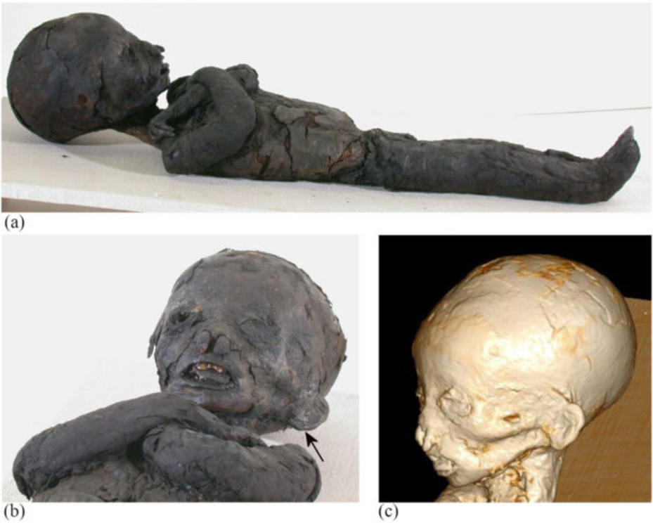 The mummy of case 2. (a) On the upper and lower limbs and the torso, there are still pieces of textiles that were used to wrap the body. Embalming substances have darkened the skin and wrappings. The child's head is longer than usual. (b) Detailed photogr