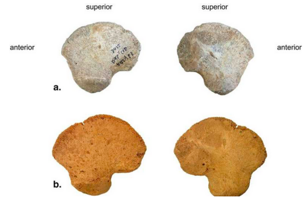 Lateral (left) and medial (right) view of (a) the right ilium (mirrored in left) of AR-63, (b) the left ilium of the perinatal Neanderthal LM2 and (c) the left ilium of a recent perinatal individual (T41). Credit: Scientific Reports (2023). DOI: 10.1038/s