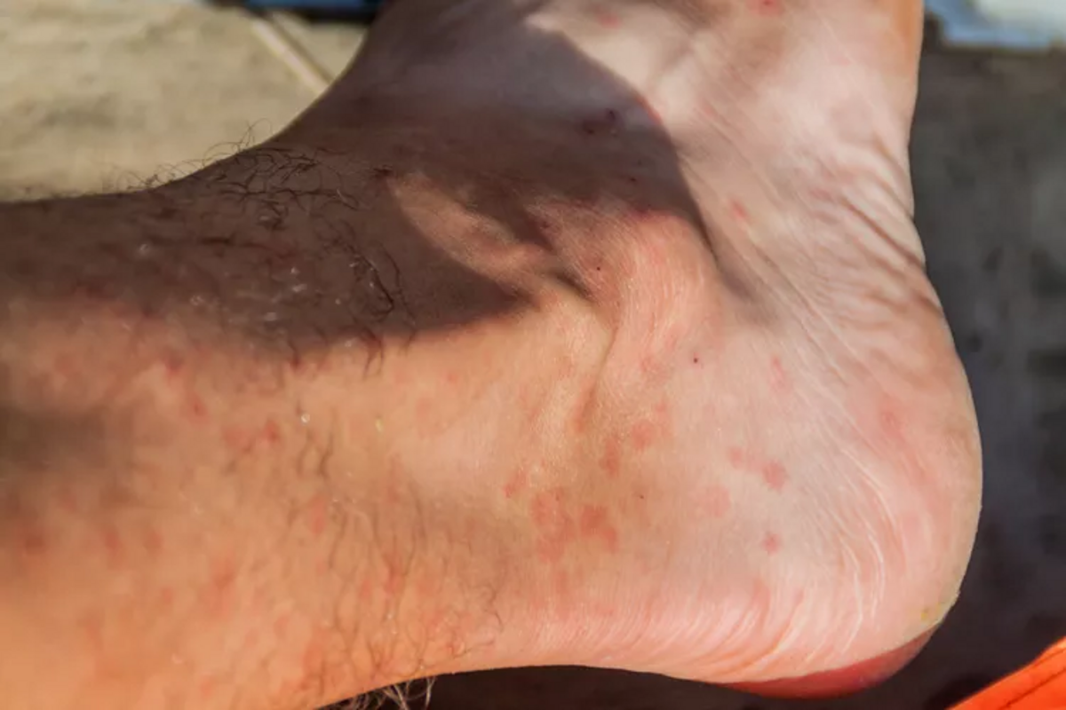 mosquito-bites-versus-sand-fly-bites-what-to-know-about-leishmaniasis