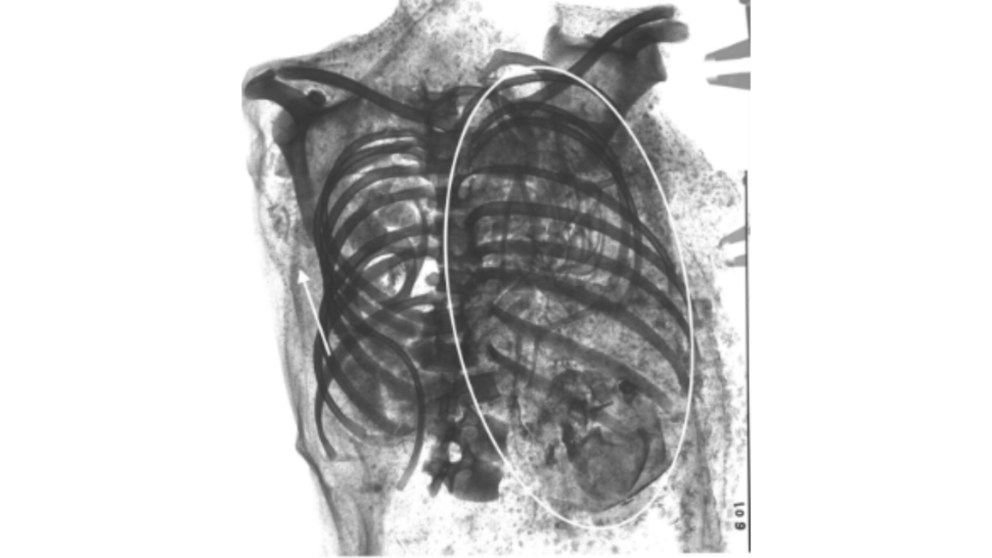 The researchers used X-rays to obtain crisp images of the mummy's torso, confirming that a fetus was lodged in the chest cavity.