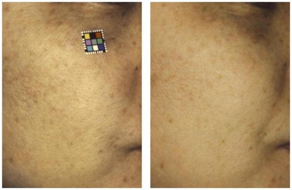 Before (left) and 6 months after (right) treatment of photodamaged skin with oral pine bark extract.